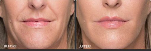 Before and After Photo