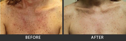 Before and After Photo