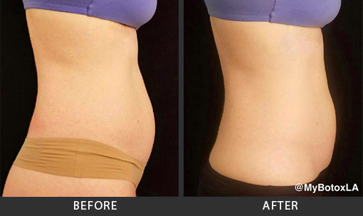 Before and After Photo