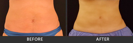 CoolSculpting Sherman Oaks, Encino & Studio City