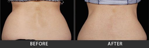 Before and After Photo