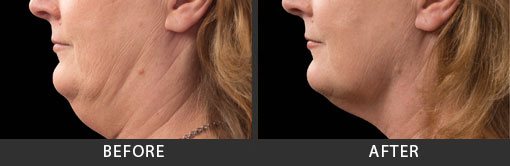 Before and After Photo