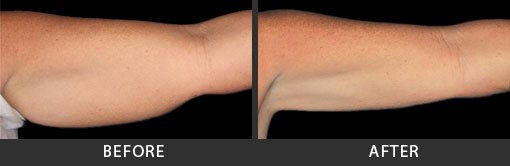 Before and After Photo