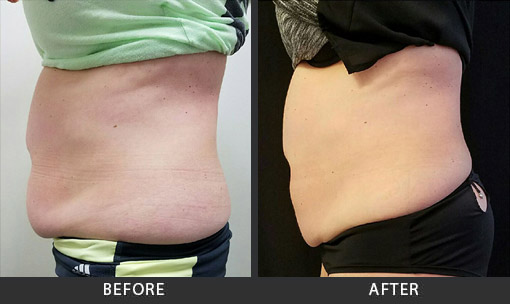 Before and After Photo