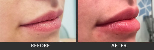 Before and After Photo