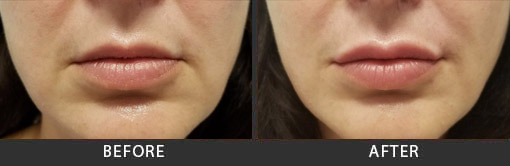 Before and After Photo