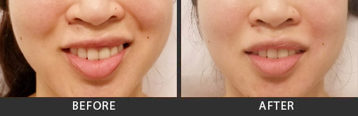 Before and After Photo