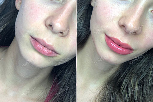 Before and After Photo