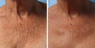 Before and After Photo