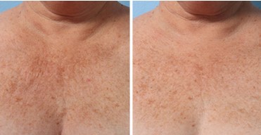 Before and After Photo