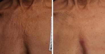 Before and After Photo