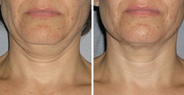 Before and After Photo