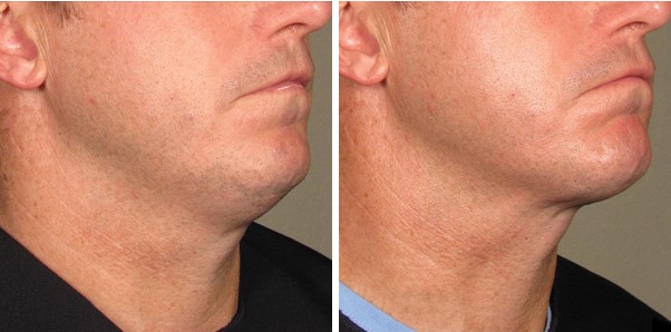 Before and After Photo