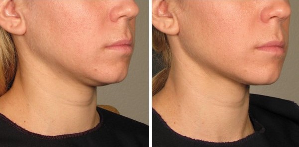 Before and After Photo