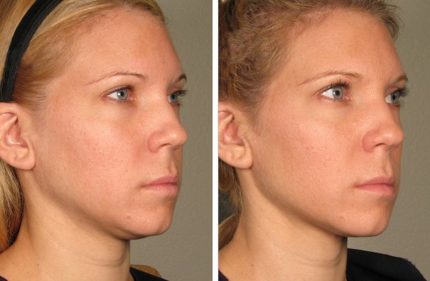 Before and After Photo